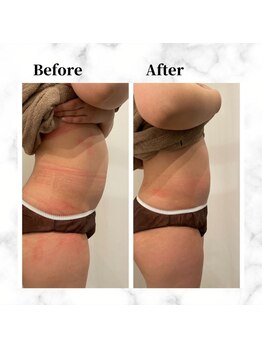 ザビューティー 麻布十番本店(The Beauty)/12Dリフトお腹美くびれ[リフト]