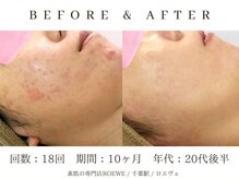 ロエヴェ(ROEWE)/ニキビ改善・毛穴ケア・肌質改善