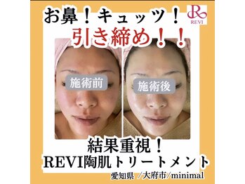 ミニマル(minimal)/肌質改善!REVIハーブピーリング