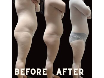 リラージェ 池袋(Relaje)/エンダモロジーbefore →after 