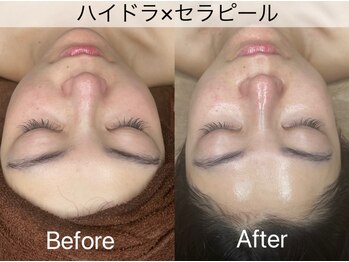 マドモアゼル 麻布十番/ハイドラ×セラピール