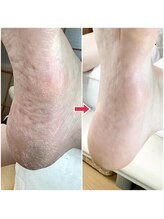 ユキネイル(YUKINAIL)/恥ずかしい、カカトのガサガサ