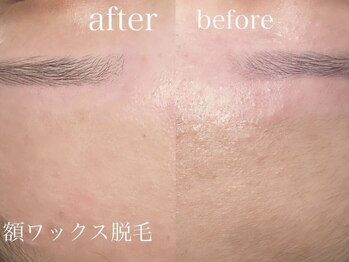 アイブロウドット 大宮(iBROW.)の写真/顔脱毛でツルスベ美肌に♪産毛もスッキリして化粧ノリもUP！お肌が弱い方にも◎お手入れ時間が快適に☆