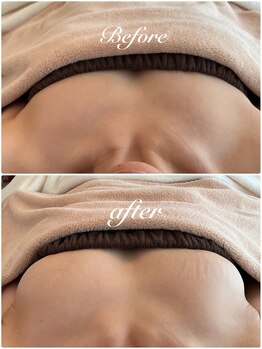 美バストアルファ(美bust α)/【バストアップ】症例