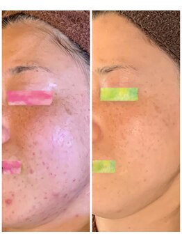 セラ(SERA)/ニキビケア