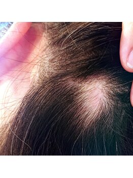 リラムーン(Relamoon)/育毛を促進♪ 要継続