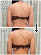 ルアナライフ(Luana Life)/短期間で背中美人《キャビゼロ》