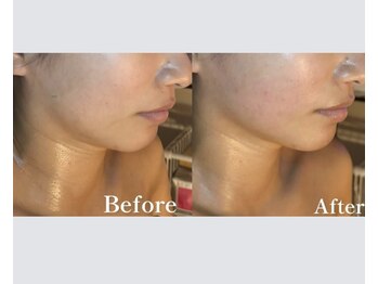 アノネ(Anone.)/リフトアップならコレ！