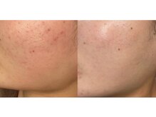 ルアーナ(Luana)/ハーブピーリング