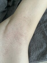 ヴァリ(VaRi)/お得に学割で脱毛