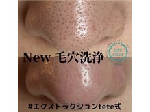 キレピア 熊本インター店(kirepia)/大人気の毛穴クリーンケア