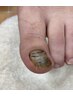 再来変形爪リセットケア2本