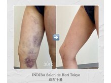 インディバホリトウキョウ(INDIBA HORI TOKYO)/ダウンタイムを最短に