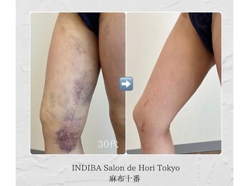 インディバホリトウキョウ(INDIBA HORI TOKYO)/ダウンタイムを最短に