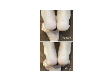 ラーナビコツ(RANA-bikotsu)/BEFORE-AFTER