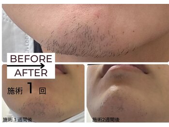 ベガ(Vega)/メンズLED脱毛