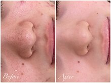 ずっと気になる毛穴にも◎滑らかに【ハーブピーリング・横浜】