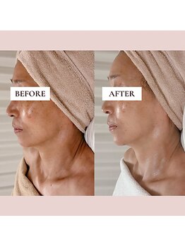 ミーティス/本気で小顔を目指す方におすすめ