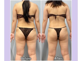 ベルミーランド 浜松天王/痩身Before→After