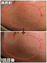 リズベット(LIZ BET)/たったの１回！シミケア放題♪