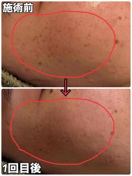 リズベット(LIZ BET)/たったの１回！シミケア放題♪