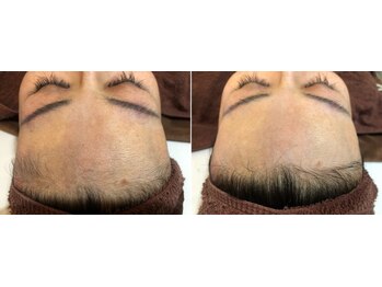 クラウドナイン(CLOUD NINE)/ビフォアアフター（お顔）