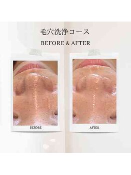 エクラ アン(eclat.un)/３０代女性：毛穴洗浄