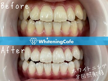 ホワイトニングカフェ 北九州小倉店(WhiteningCafe)/◎歯のホワイトニング施術写真◎