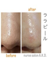 エーケーディー(A.K.D.)/ララピール