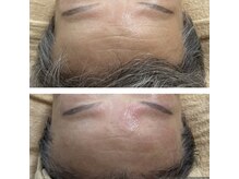 リバイセリー(Revicelly)/比較写真