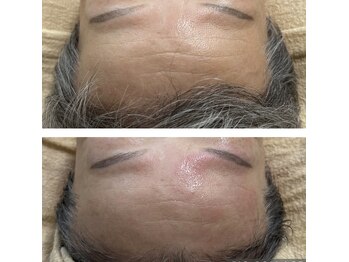 リバイセリー(Revicelly)/比較写真