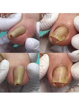 巻き爪補正店 大分店の写真/巻き爪のスペシャリストによる施術で長年の爪の悩みを解消！【カウンセリング込】