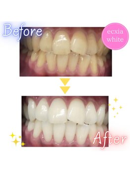 エクシアホワイトフジ(ecxia white fuji)/ホワイトニングビフォーアフター
