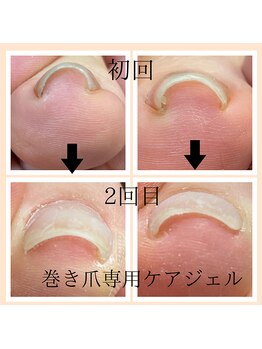 シュシュ(Chou chou)/巻き爪のストレスを改善します