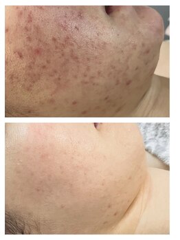 エリー(ERIE)/肌質改善（赤ニキビケア）