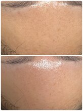 ナナラ(NANALA)/クレイ泥パックの力が最強！！