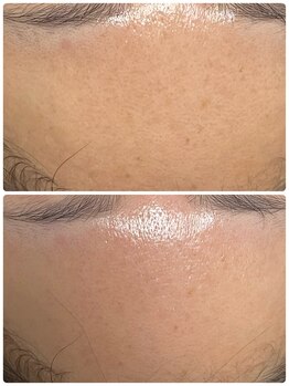 ナナラ(NANALA)/クレイ泥パックの力が最強!!