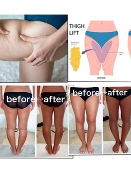 ウラヤス 恵比寿(Urayasu)/セル脂肪筋膜リリース