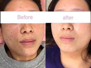 サクラ 本厚木駅前店(SAKURA)/【本厚木/シミケア/たるみケア】