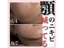 ホワイトアクア 天王寺本店(WHITE AQUA)/ハーブピーリング/大阪/天王寺