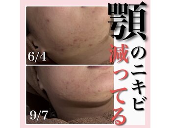 ホワイトアクア 天王寺本店(WHITE AQUA)/ハーブピーリング/大阪/天王寺