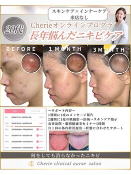 シェリー(Cherie)/【ニキビ】の原因を舌から見る