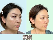 ナチュラルパーフェクトフェイス 新宿/整った横顔/新宿駅小顔矯正