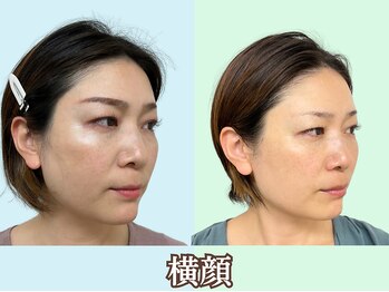 ナチュラルパーフェクトフェイス 新宿/整った横顔/新宿駅小顔矯正