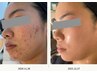 【メンズフェイシャル】メンズ水光ピール◆本気の肌改善ケアをお考えの方に◆