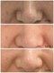 トリートメントルーム フェリーチェ(Felice)の写真/乾燥毛穴・たるみ毛穴・ファンデの毛穴落ち・・40代からの毛穴対策はハリが鍵!土台から整えて毛穴レス肌へ