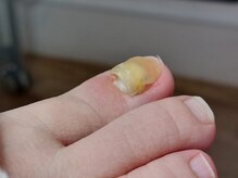 爪切り屋 足楽/変形爪ケア【before】