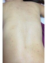 スキンケアスタジオ アコ 新宿店(Aco)/グリーンピールボディ１D１回