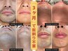 【本日限定】初回ヒゲ脱毛¥5,500→¥2,980 ※効果実感できなければ料金不要