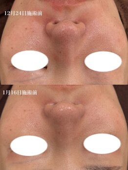 テンニック(10nick)/1ヶ月の変化、毛穴